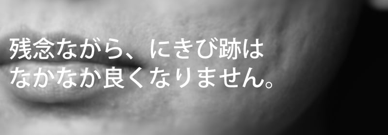 残念ながらにきび跡はよくなりません