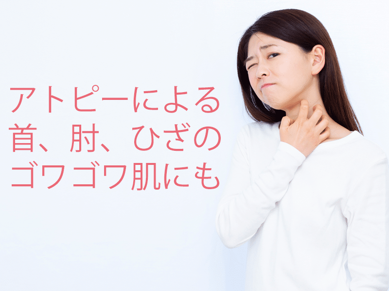 かかとだけでなくアトピーで硬くなった首や腕、膝の内側部分のゴワゴワ、ザラザラ部分にも有効