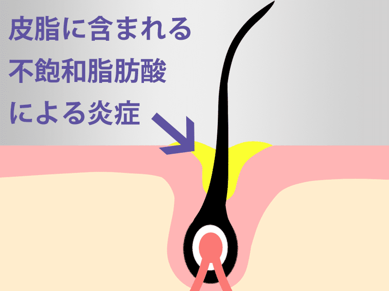 毛穴の開きは、皮脂に含まれる不飽和脂肪酸による炎症で始まります。グリシルグリシンは毛穴の開きに有効といわれています。