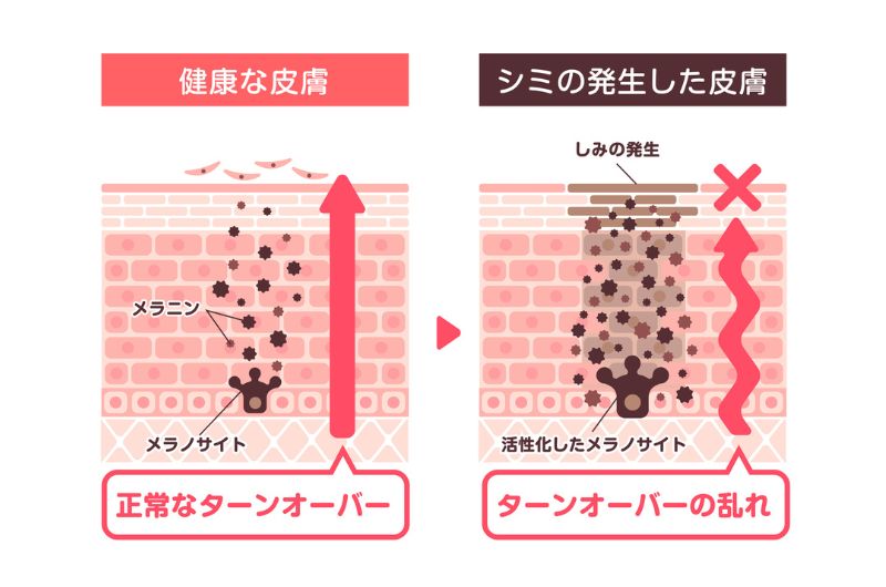 シミが発生した皮膚